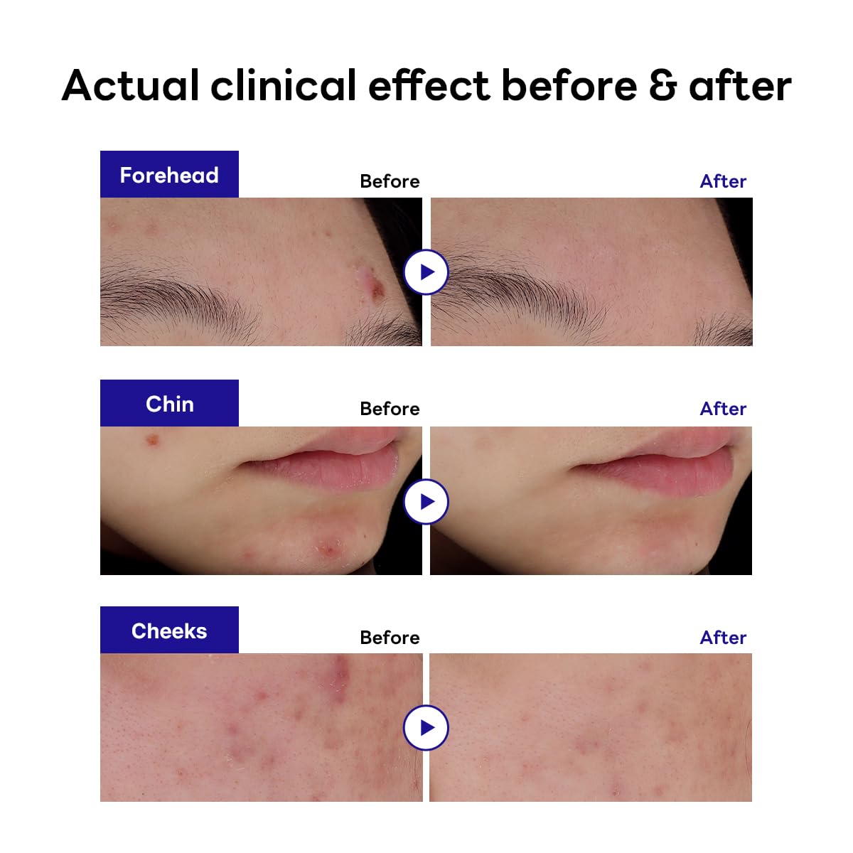 MEDIHEAL MADECASSOSIDE BLEMISH SPOT PATCH