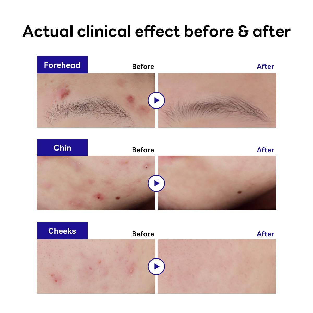 MEDIHEAL DERMA CLEAR TEATREE TROUBLE SPOT PATCH 132 CT